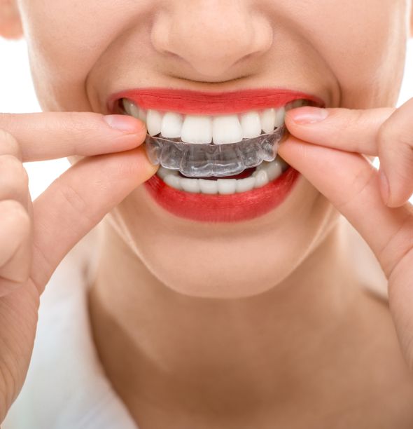 İnvisalign